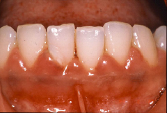 歯肉炎の写真