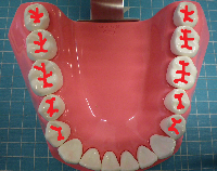 奥歯の溝の写真